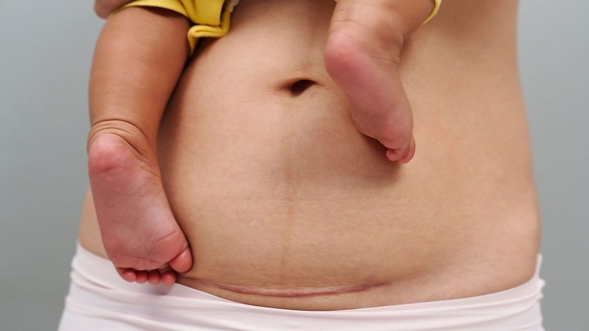 Recuperación post-cesárea Revista Digital Mamás360 Embarazo y Maternidad